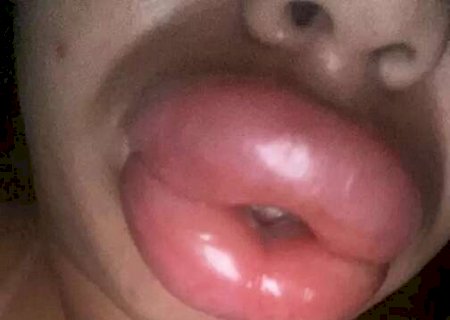 'Doutora' que prometia bocão atuava há 1 ano e comprava ácido em rede social